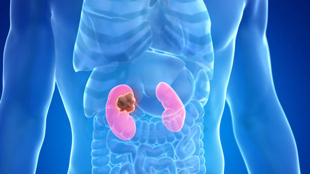 Kidney Cancer diagram