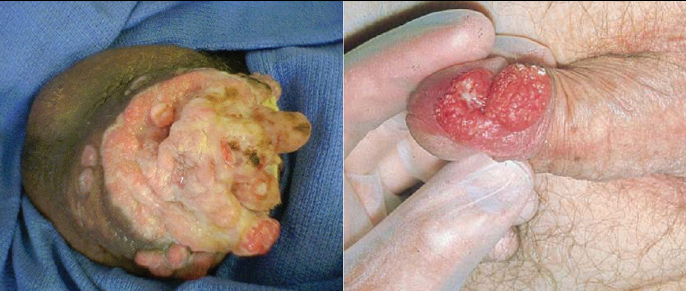 Penile Cancer