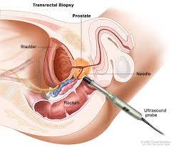 Prostate Cancer