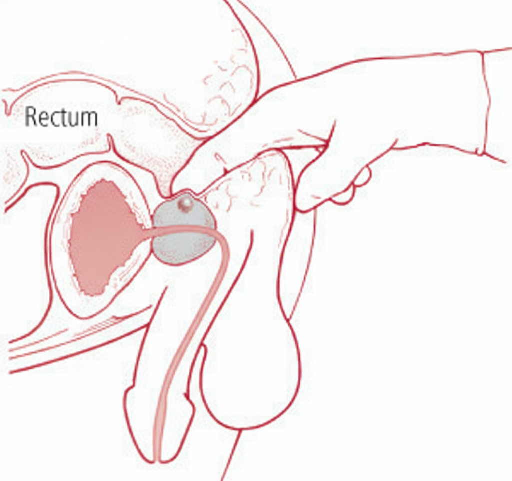 Prostate Cancer