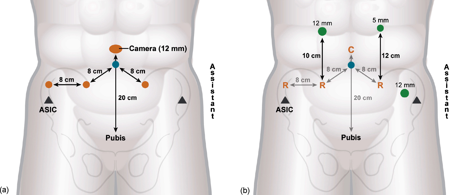 Patient Guide: Robotic Radical Cystectomy (RARC)