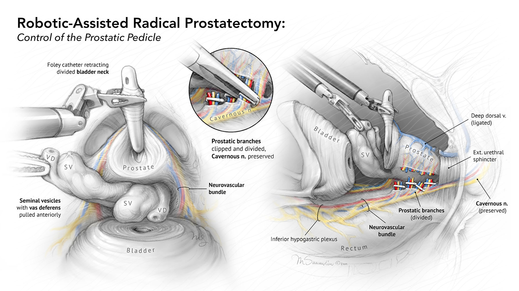RARP