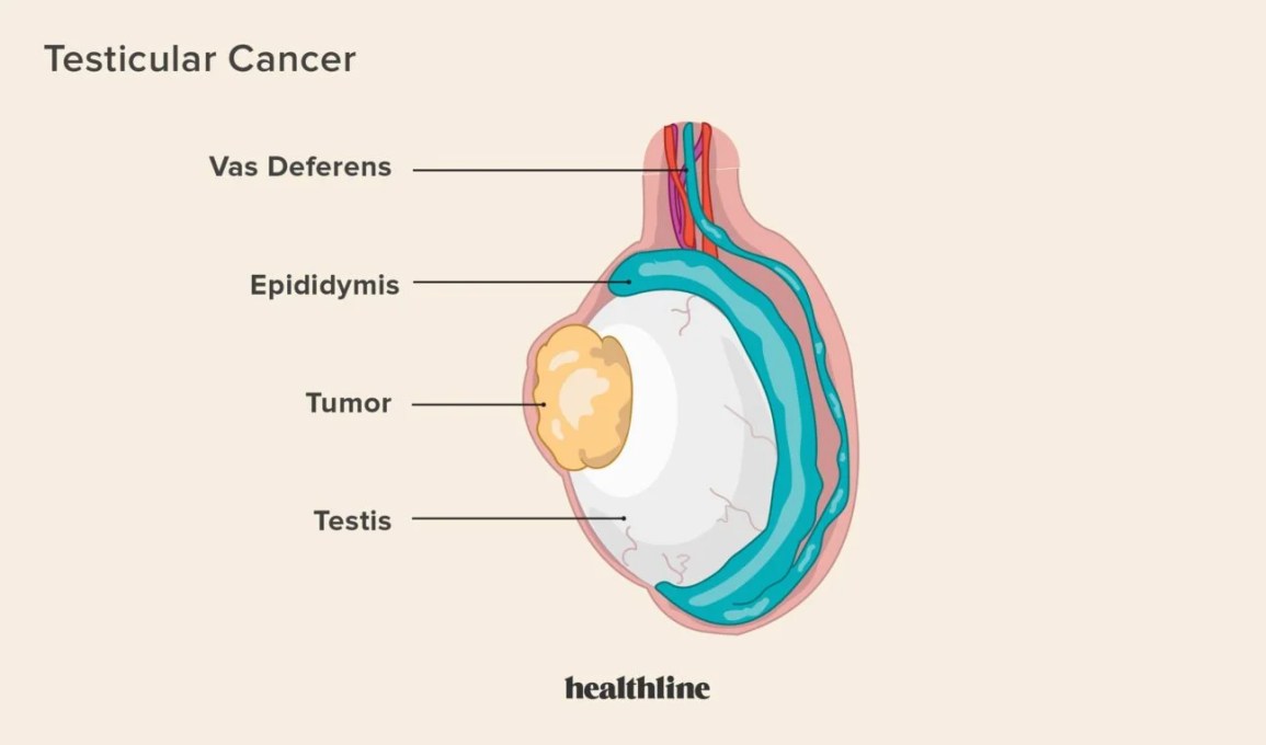 Testicular Cancer diagram